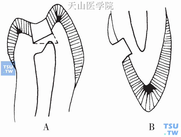 前磨牙与上前牙Ⅰ类洞