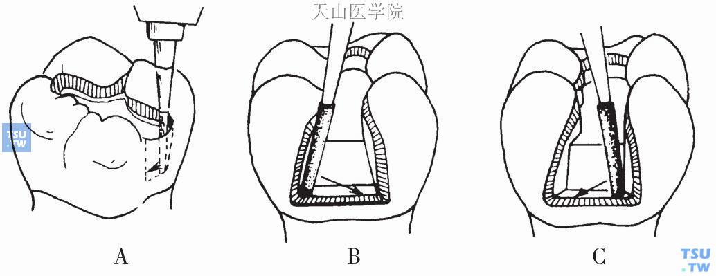 口腔二类洞制备步骤图片