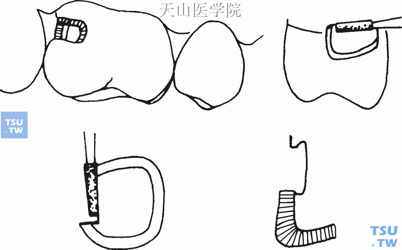 后牙邻面Ⅱ类洞侧面制备