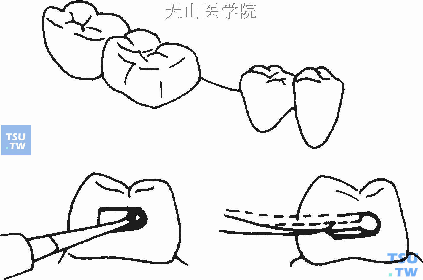 后牙单面Ⅱ类洞的制备