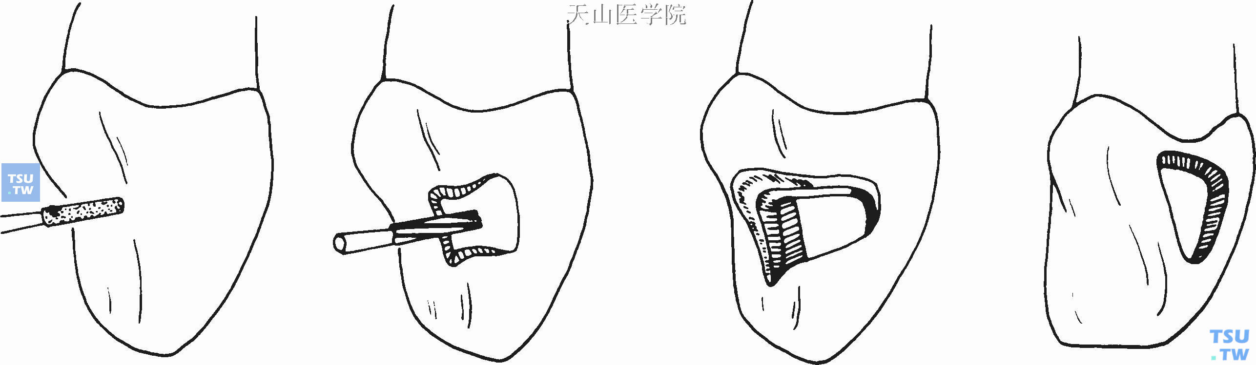 Ⅲ类洞的制备