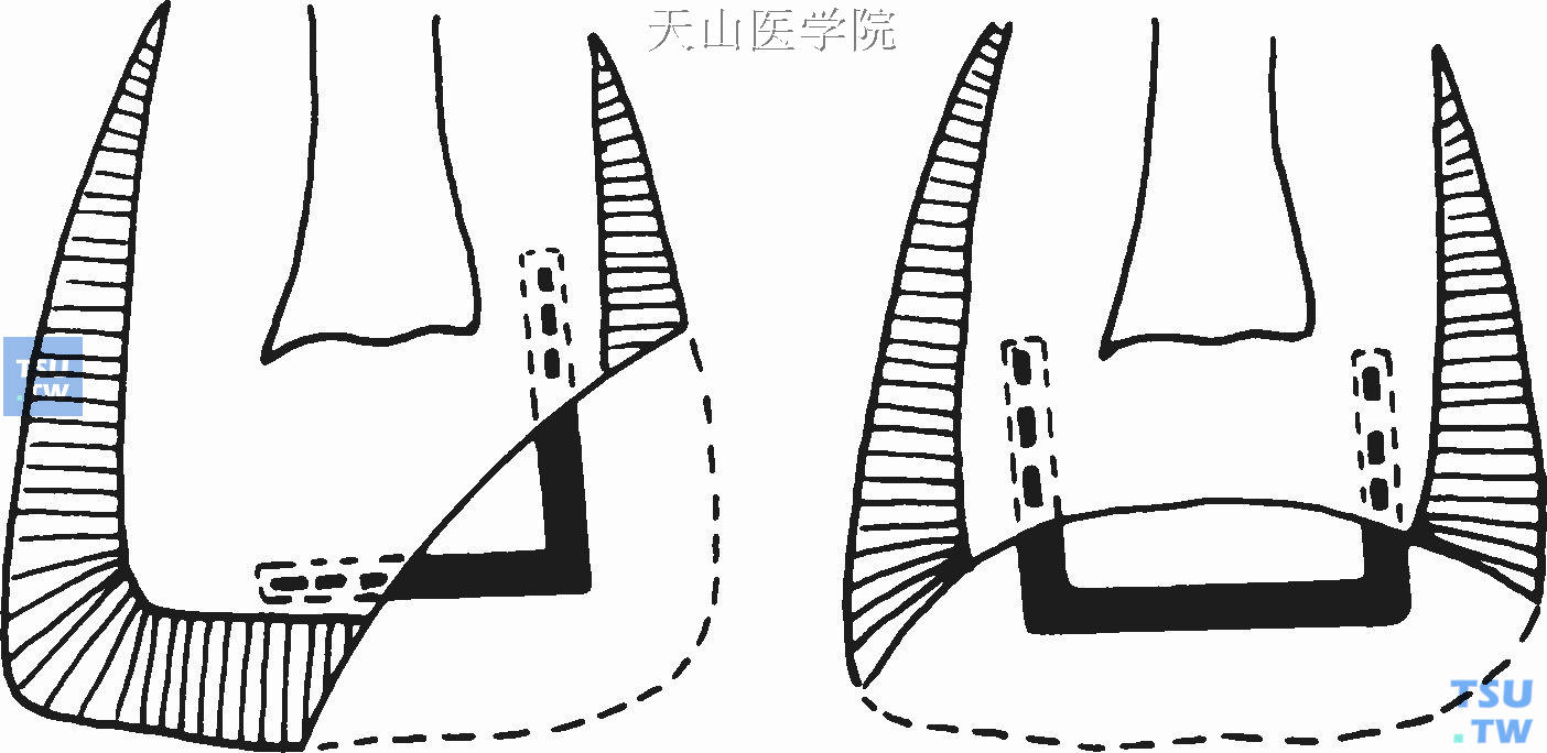 Ⅳ类洞的支架固位