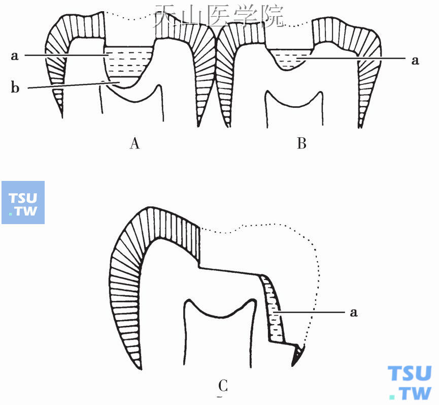 深洞垫底  A．双层垫底;B．单层垫底;C．轴壁垫底a．磷酸锌粘固粉;b．氧化锌粘固粉