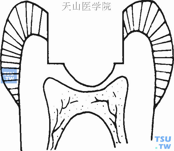 深龋洞形制备