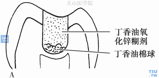 深龋的治疗方法