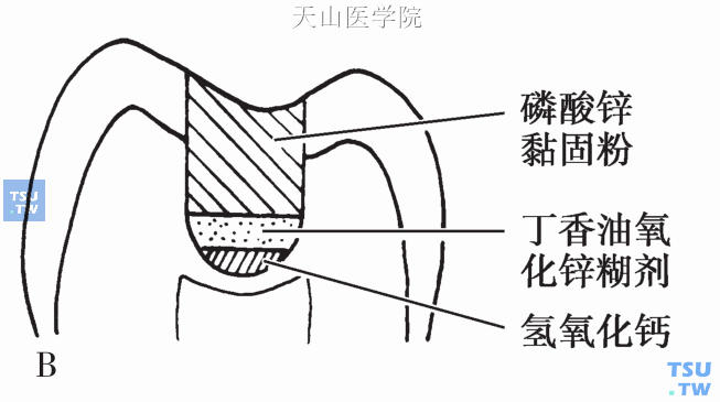 深龋的治疗方法