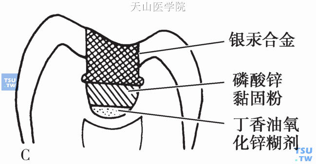 深龋（快要伤及牙髓的蛀牙）治疗