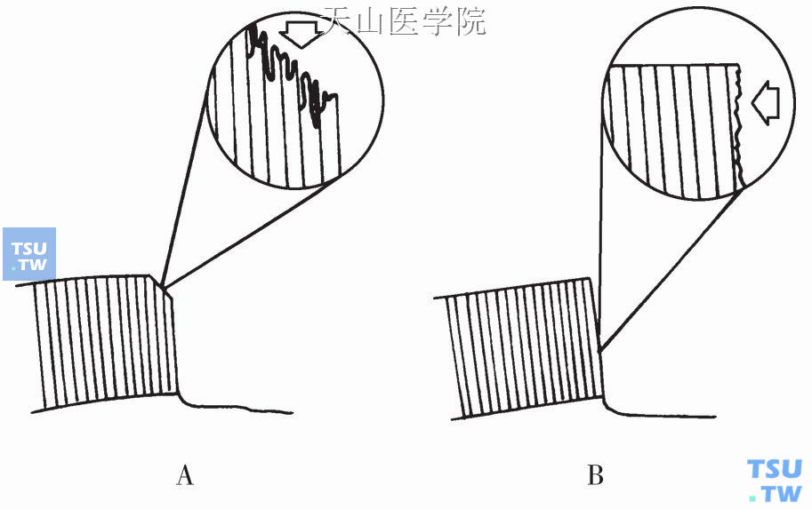 补牙：牙体组织的粘接