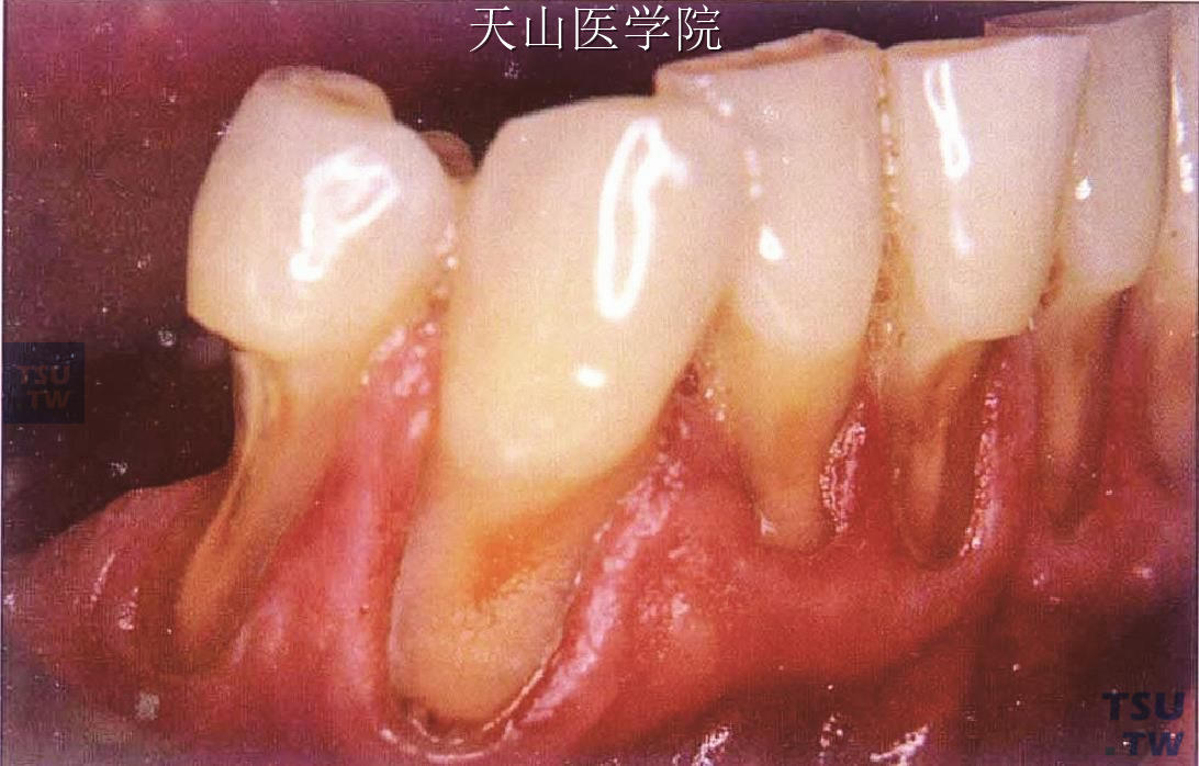 牙齿楔状缺损