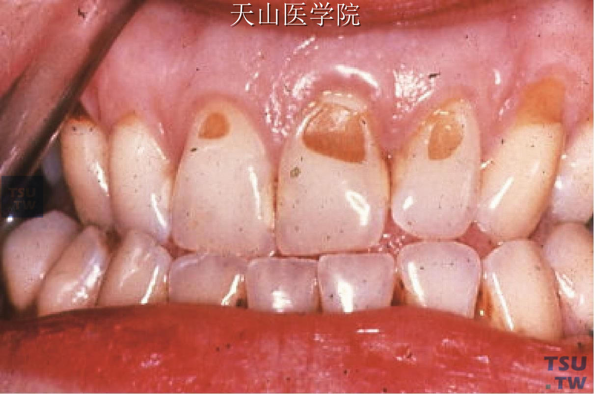牙酸蚀症