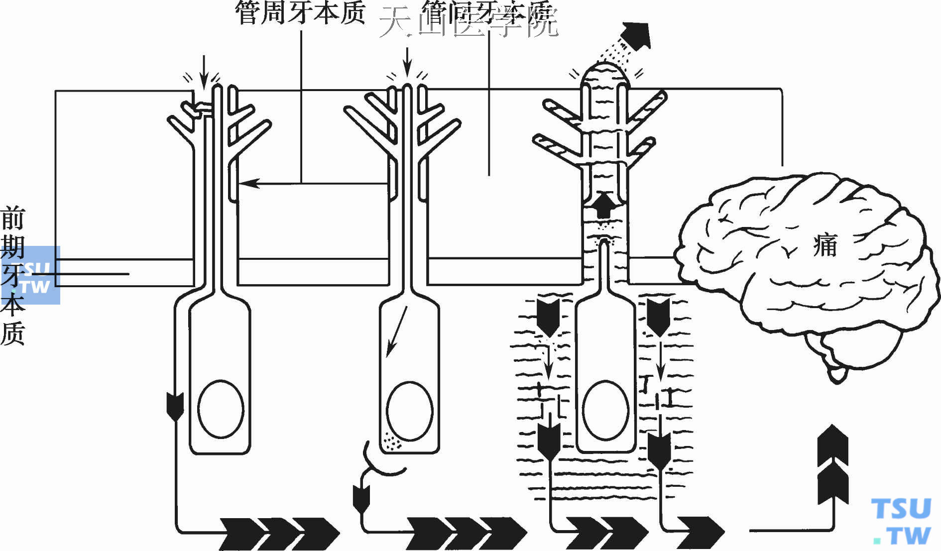 牙本质敏感发病的3种假说