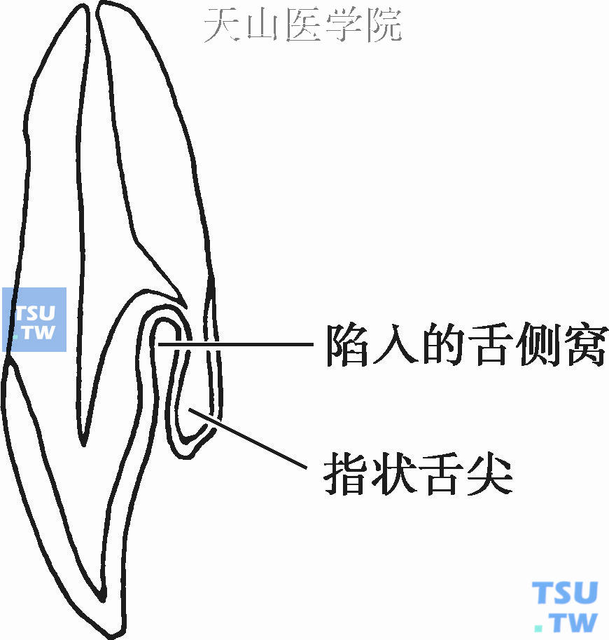 畸形舌侧窝