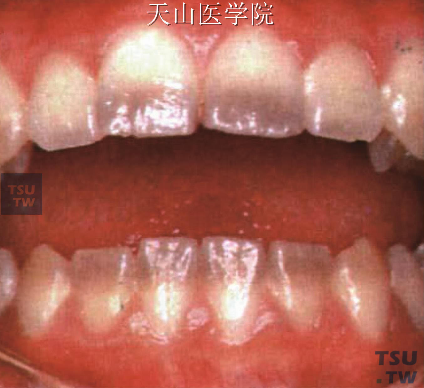 四环素牙的病因及树脂遮盖、漂白治疗