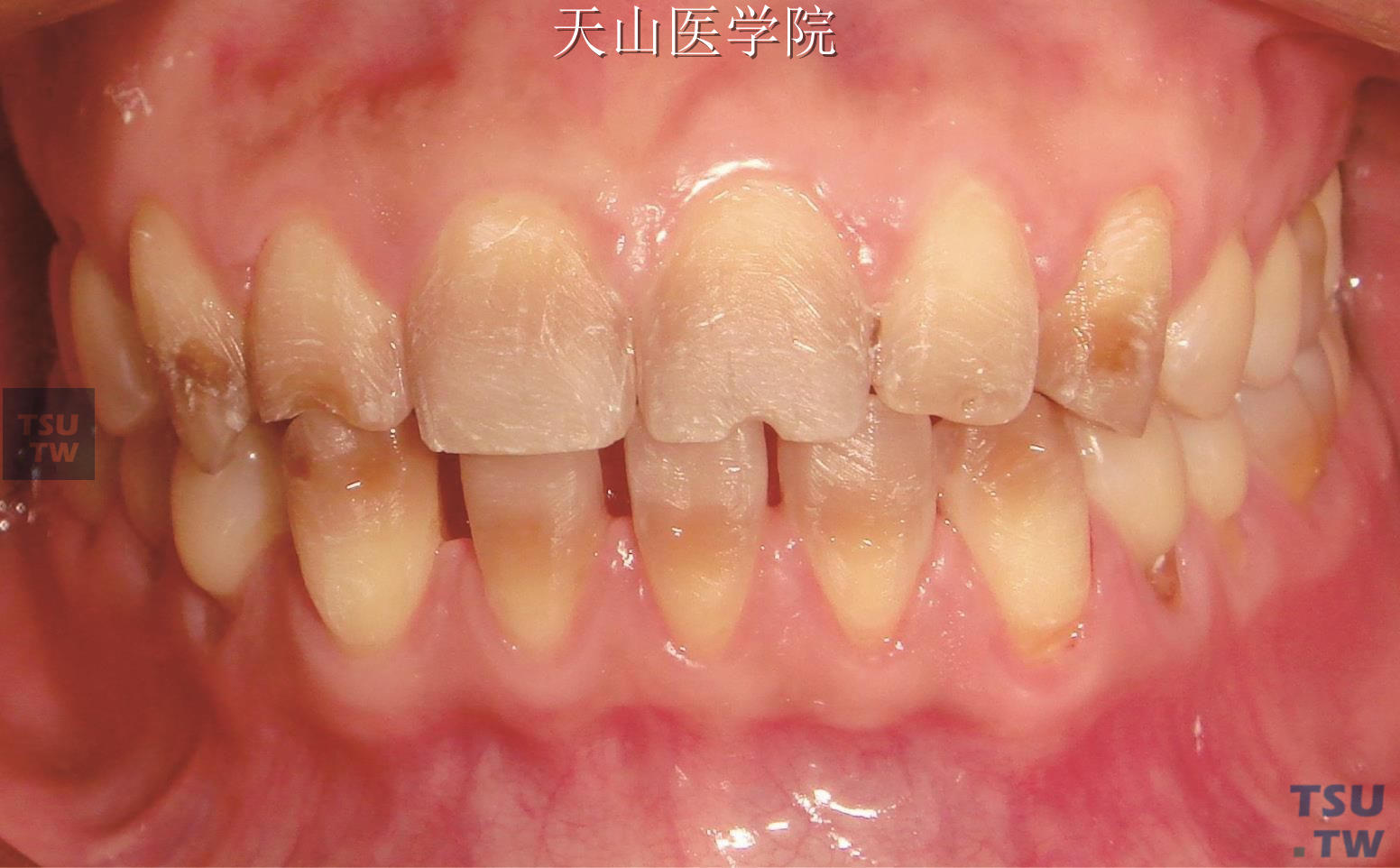 冷光牙齿对比照片(四环素牙)-赵振的博客-KQ88口腔博客
