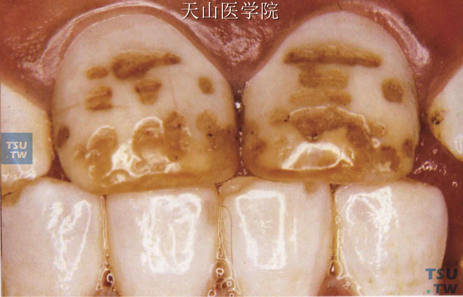 关于氟斑牙（氟牙症）