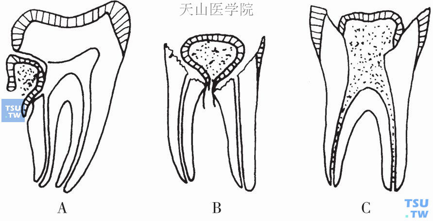 慢性增生型牙髓炎（C）与牙龈息肉（A、B）