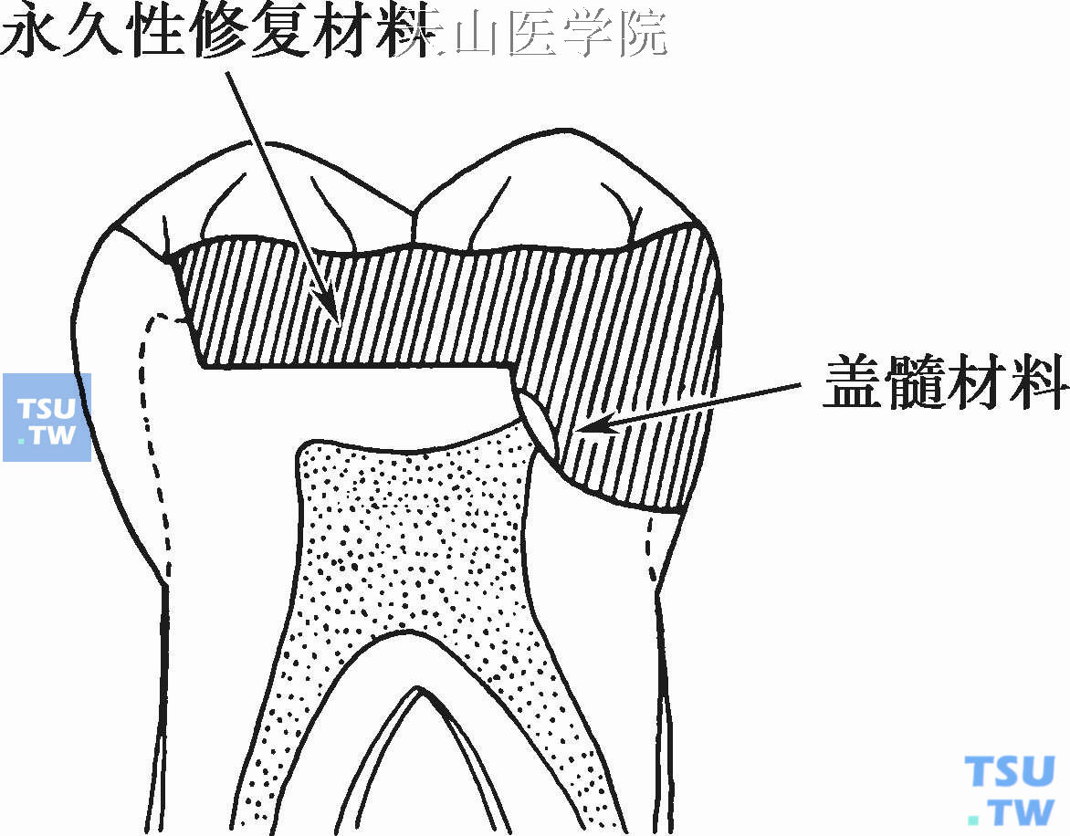 直接盖髓术