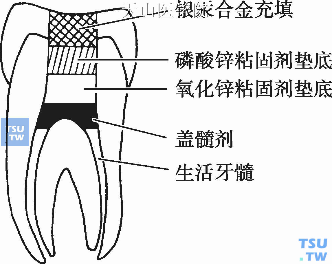 牙髓切断术