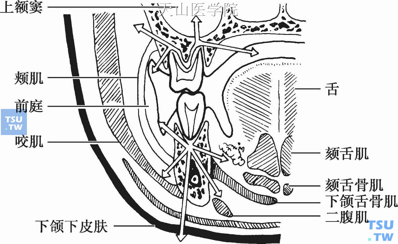 根尖周炎排脓途径