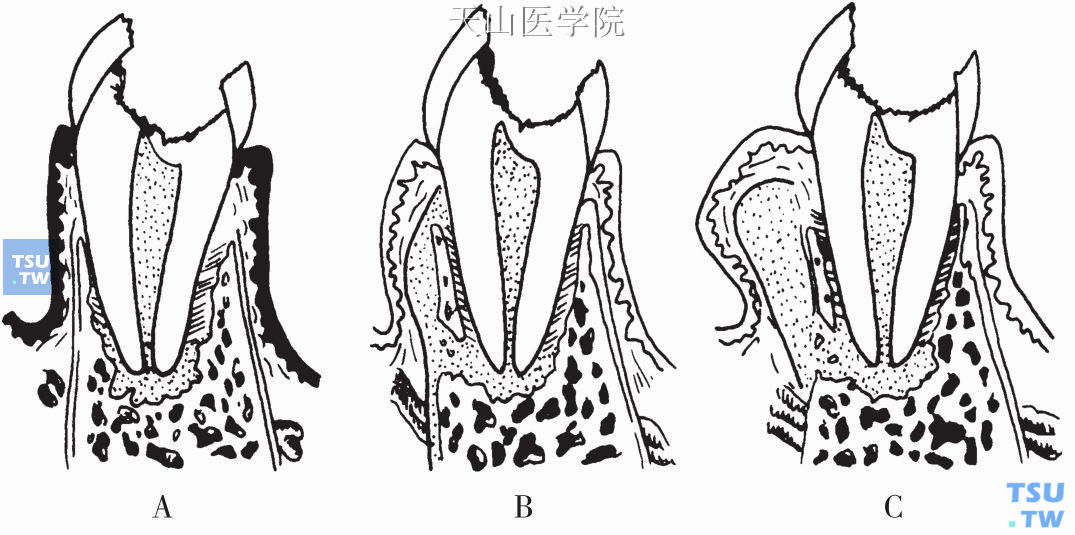 根尖周炎的发展过程  A．根尖周脓肿;B．骨膜下脓肿;C．黏膜下脓肿