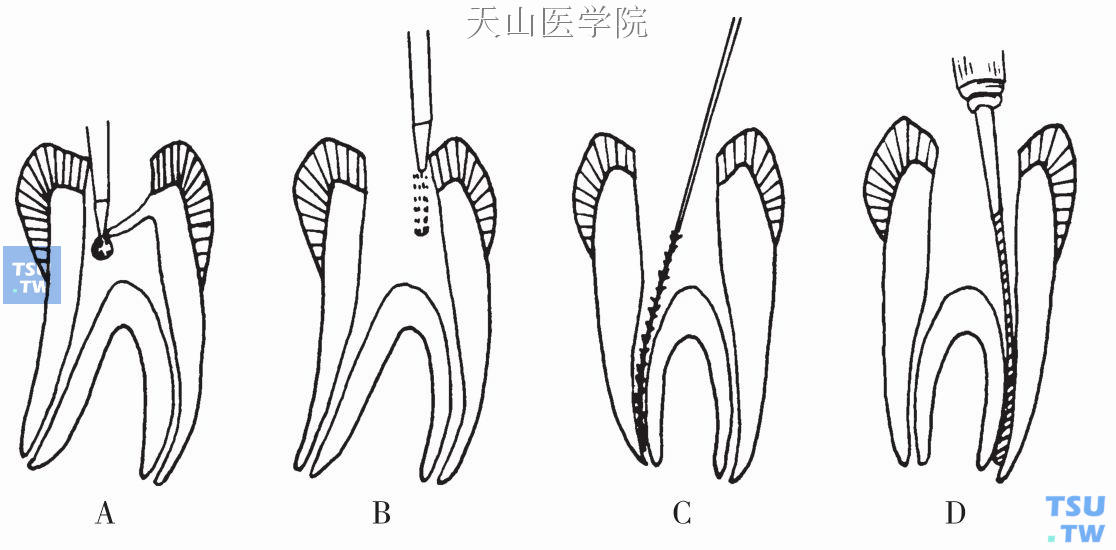 根管预备的步骤  A．揭开髓室顶;B．修整洞壁;C．摘除根髓;D．扩大根管