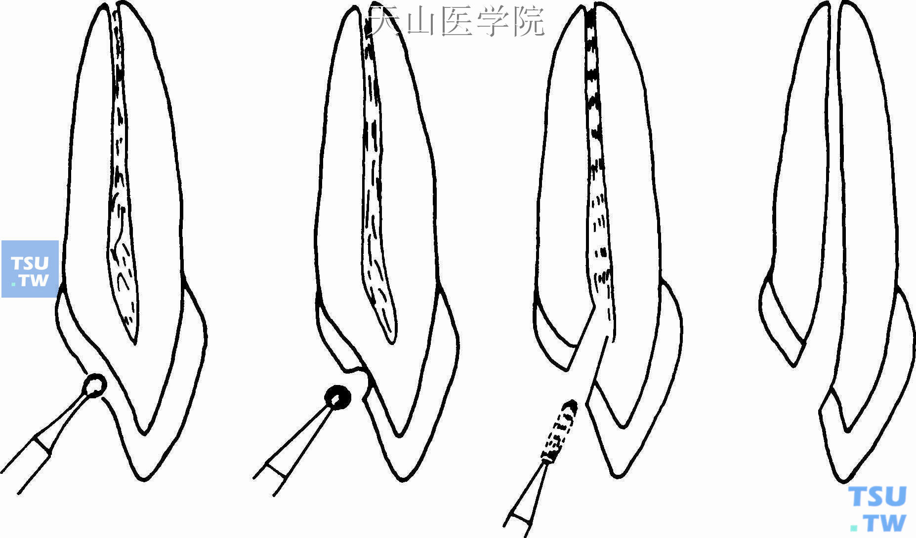 根管治疗的前牙开髓法