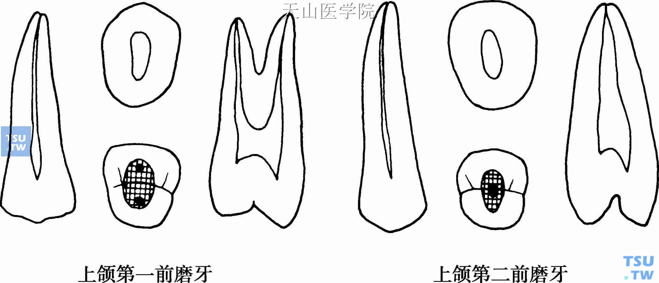 上颌前磨牙髓腔形态及开髓洞形