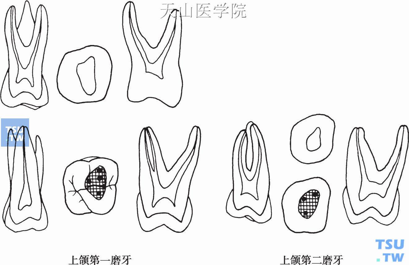 上颌磨牙髓腔形态及开髓洞形