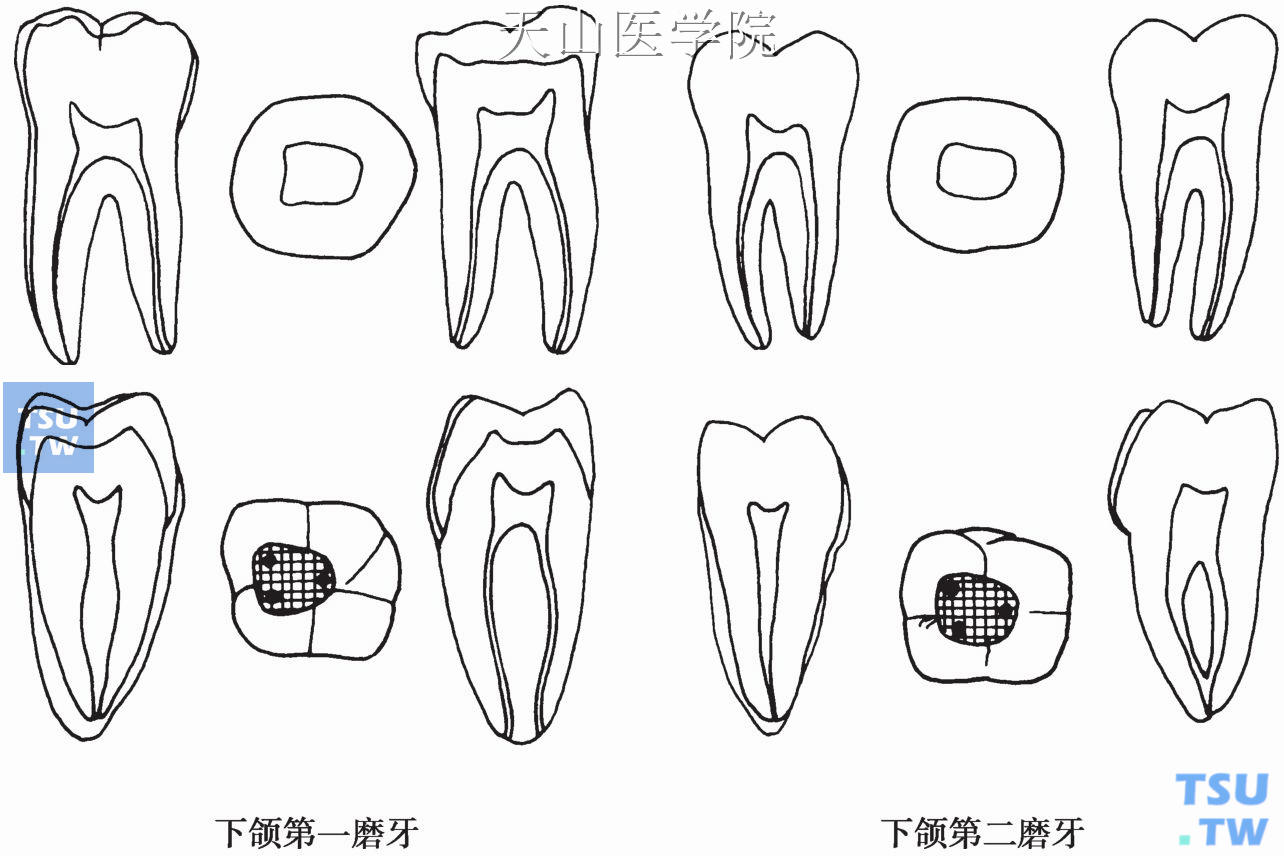 下颌磨牙髓腔形态及开髓洞形