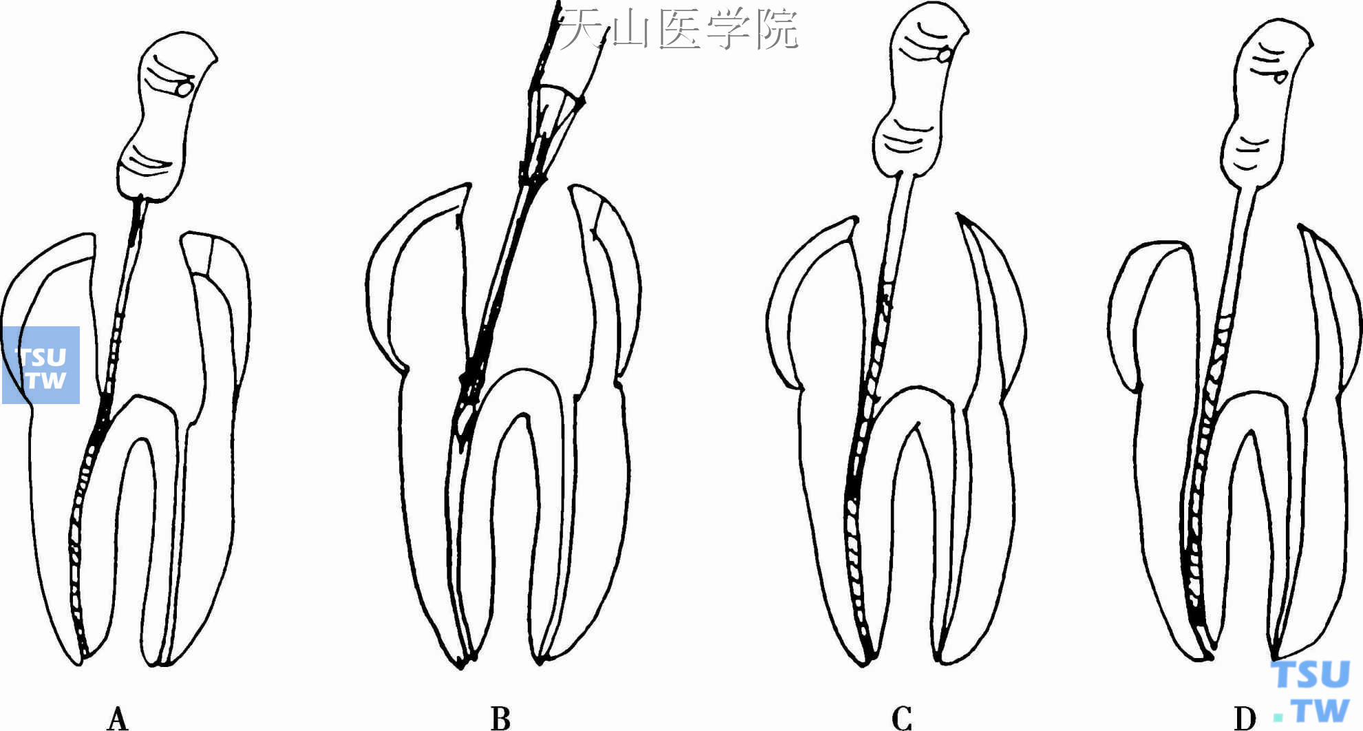 逐步深入法  A．弯曲根管疏通;B．G钻敞开根上段;C．根尖段预备;D．逐步后退