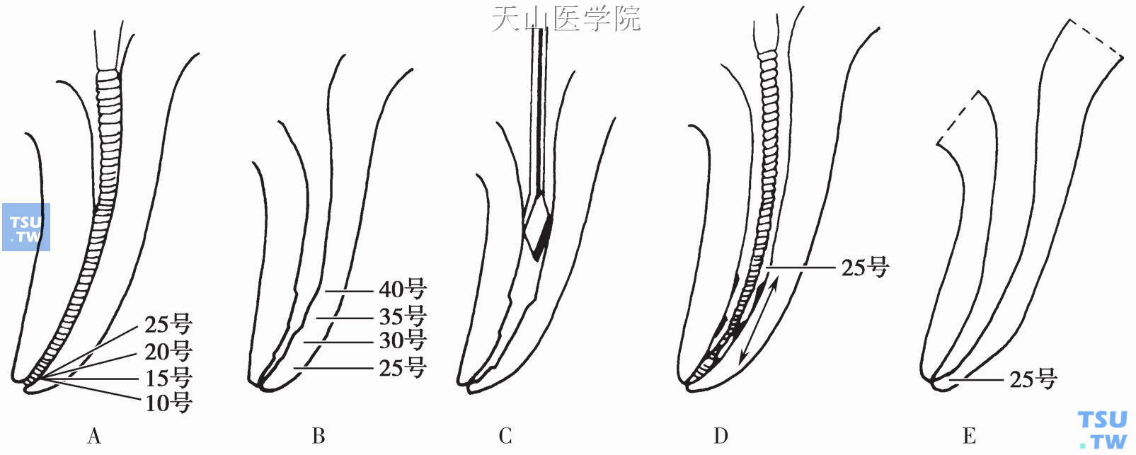 逐步后退法  A．根尖预备;B．根中段预备;C．根管上段预备;D．去除台阶;E．根管预备完成