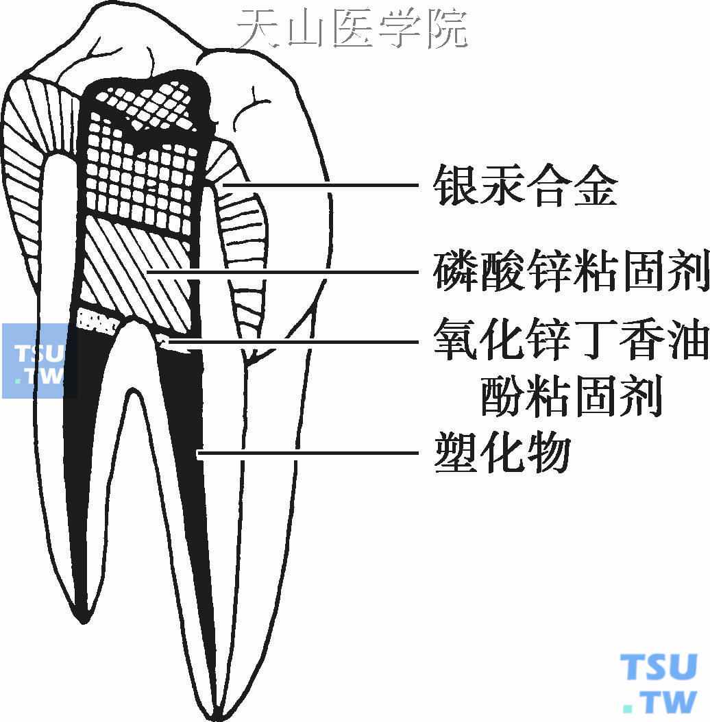 牙髓塑化治疗