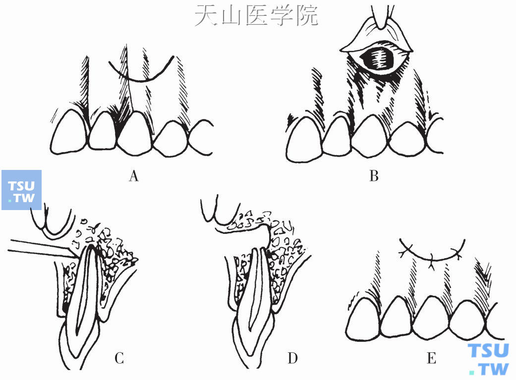 根尖切除术