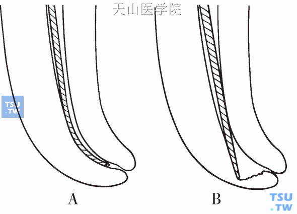 传统不锈钢扩锉针预备弯曲根管造成根管偏移示意图