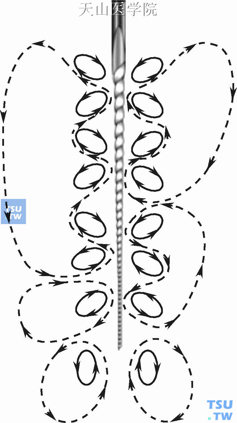 超声波对根管的清洁作用机制示意图