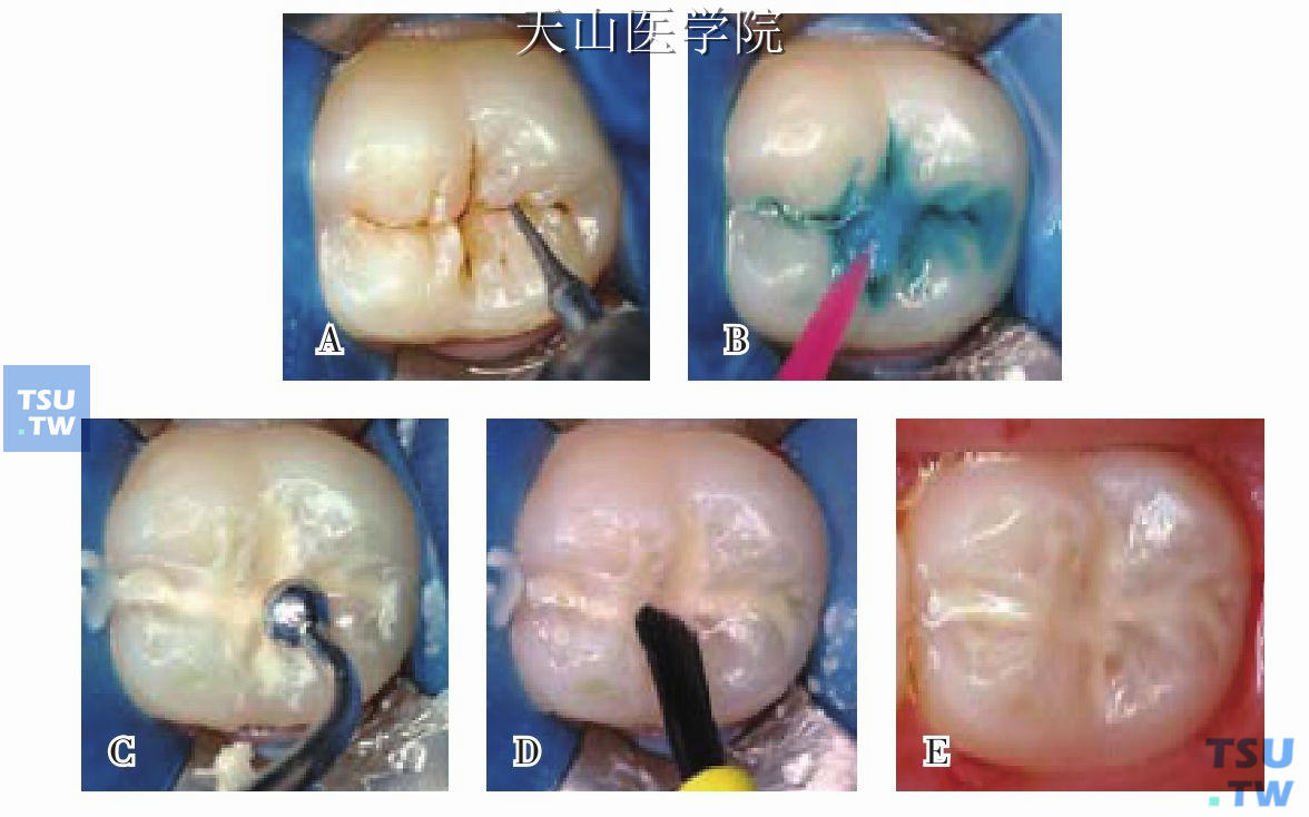 预防性树脂充填