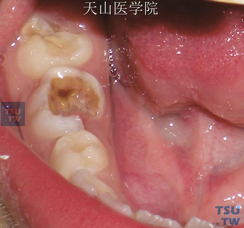 年轻恒牙龋病的治疗特点