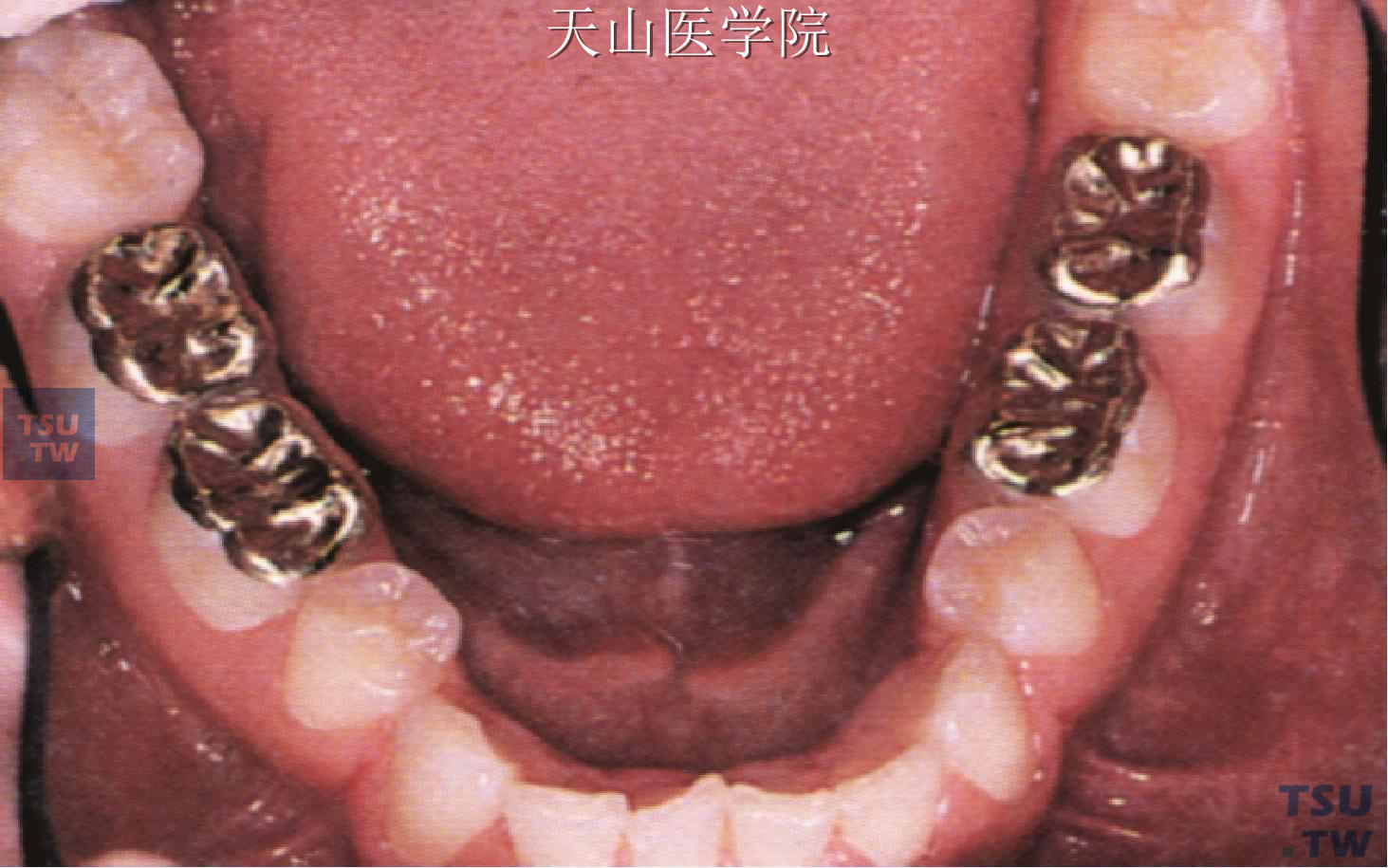 下颌第二乳磨牙及第一恒磨牙的金合金嵌体