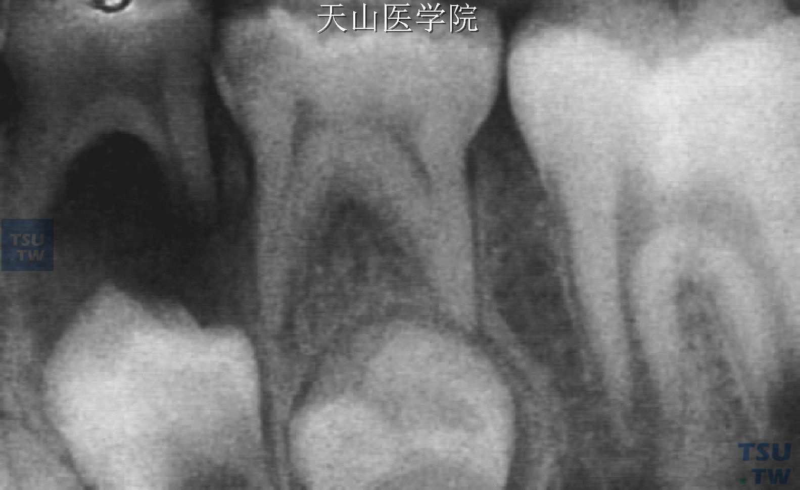 X线片显示第一乳磨牙根尖周病累及其下恒牙胚