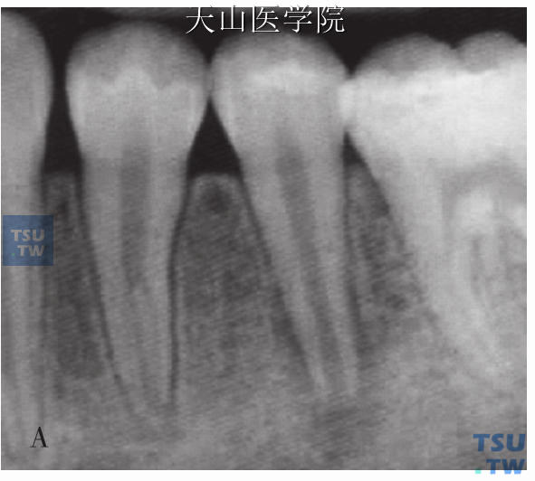 年轻恒牙根尖周炎及根尖诱导成形术