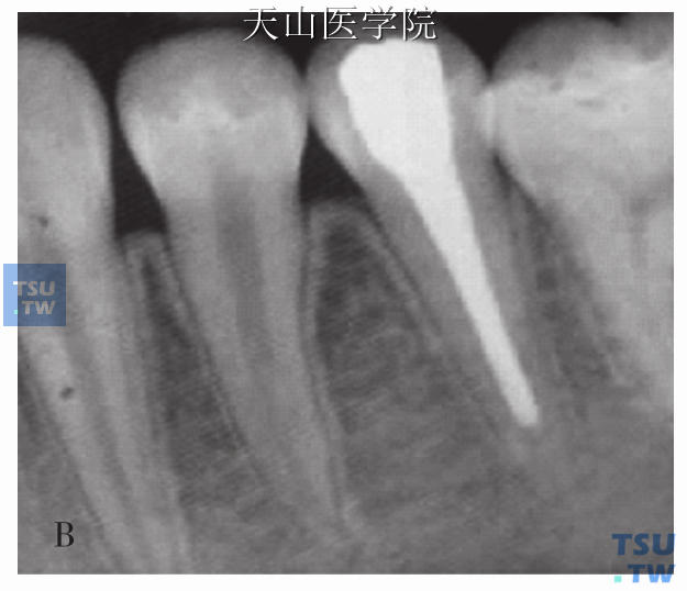 儿童牙髓及根尖周病的诊断和治疗