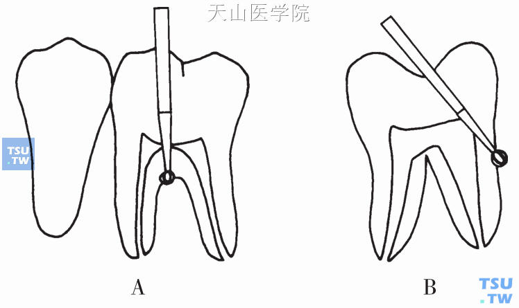 根管治疗期间的疼痛处理