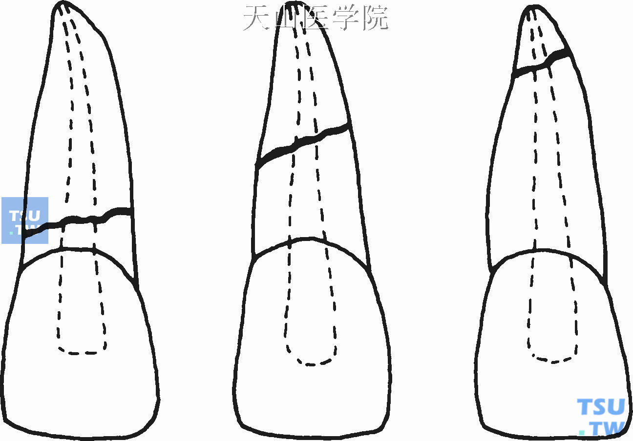 牙齿折断的处理