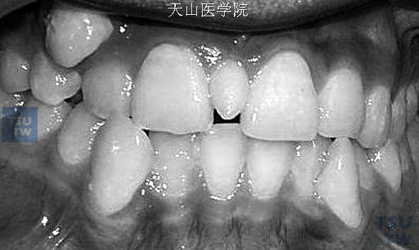 错牙合畸形的病因