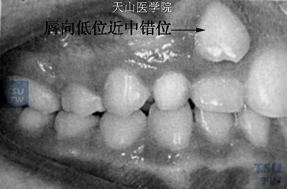 尖牙唇向、低位及近中错位