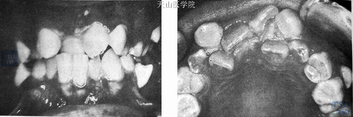 牙弓狭窄　常表现为牙列拥挤，如出现在上颌牙弓，常见腭盖高