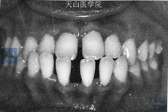 牙弓宽大　常表现为牙齿稀疏，牙齿间有散在间隙