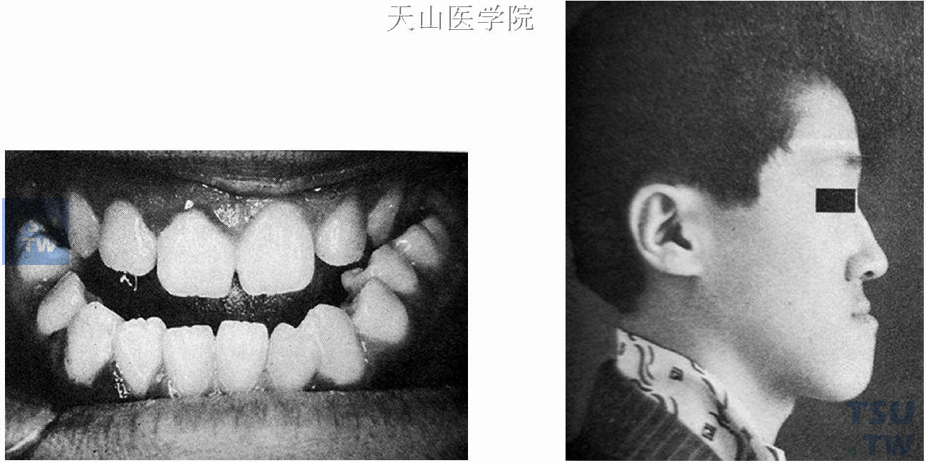 前牙反牙合，近中错牙合，骨性下颌前突