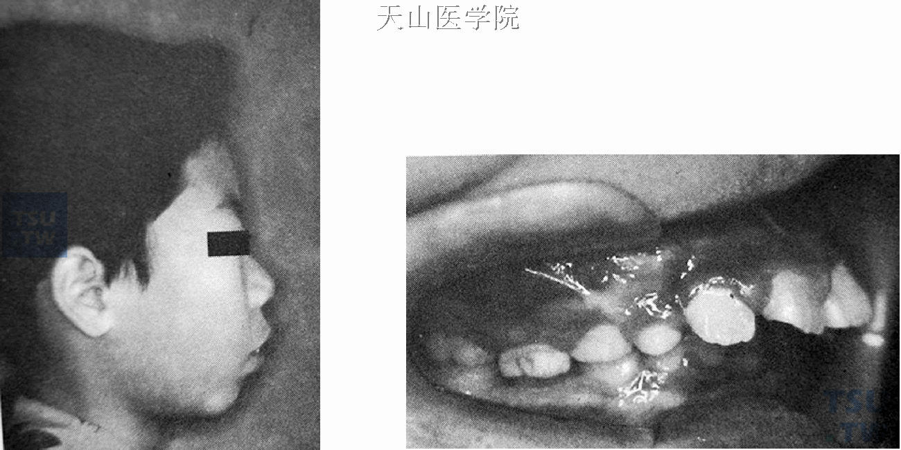 前牙深覆盖，远中错牙合，上颌前突