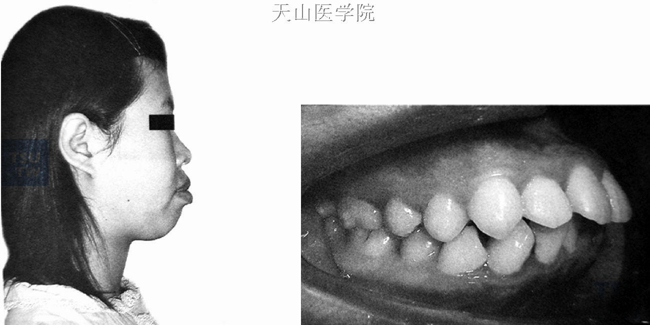 上下牙弓前突，双颌前突